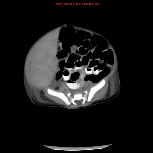 File:Neonatal neuroblastoma (Radiopaedia 9564-10223 A 38).jpg