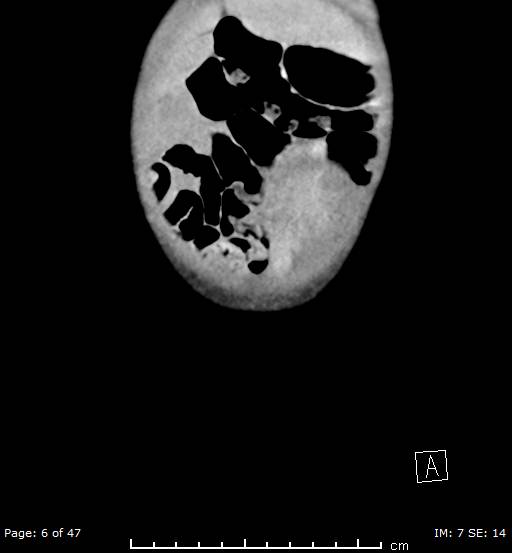File:Neuroblastoma (Radiopaedia 41472-44355 B 6).jpg