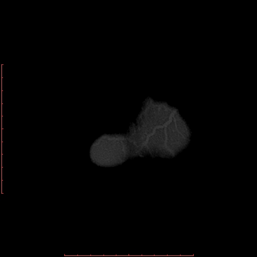File:Neuroblastoma skull metastasis (Radiopaedia 56053-62683 Axial bone window 27).jpg