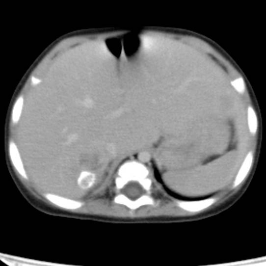 Neuroblastoma with skull metastases (Radiopaedia 30326-30960 C 10).jpg