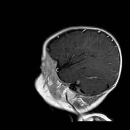File:Neurofibromatosis type 1 (Radiopaedia 30089-30671 Sagittal T1 C+ 1).jpg