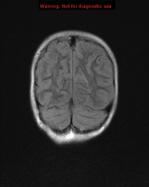 File:Neurofibromatosis type 1 with optic nerve glioma (Radiopaedia 16288-15965 Coronal FLAIR 4).jpg