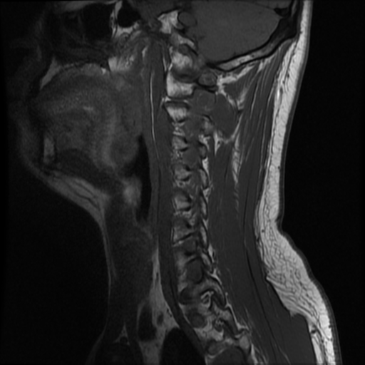 File:Neurofibromatosis type 2 (Radiopaedia 44936-48837 Sagittal T1 12).png