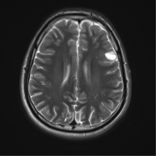 File:Neurofibromatosis type 2 (Radiopaedia 44936-48838 Axial T2 16).png