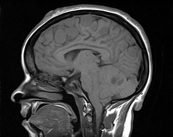 File:Neurofibromatosis type 2 (Radiopaedia 66211-75401 Sagittal T1 14).jpg