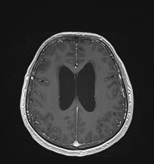 Neurofibromatosis type 2 (Radiopaedia 79097-92049 Axial T1 C+ 132).jpg