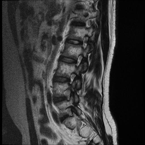 File:Neurofibromatosis type 2 (spinal manifestations) (Radiopaedia 53943-60070 E 4).png