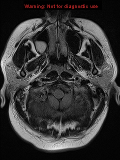 File:Neuroglial cyst (Radiopaedia 10713-11184 Axial FLAIR 21).jpg