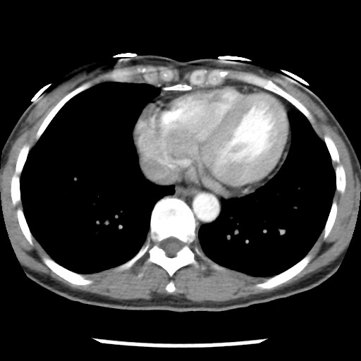 File:Non-small cell lung cancer with miliary metastases (Radiopaedia 23995-24193 A 30).jpg