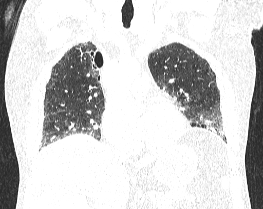 Non-specific interstitial pneumonia (NSIP) (Radiopaedia 68599-78228 Coronal lung window 38).jpg