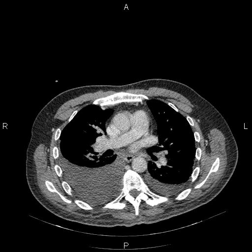 File:Non Hodgkin lymphoma in a patient with ankylosing spondylitis (Radiopaedia 84323-99624 B 14).jpg