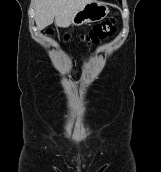 Normal CT intravenous urogram (Radiopaedia 39444-41759 A 184).jpg