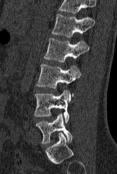 File:Normal CT lumbar spine (Radiopaedia 53981-60118 Sagittal bone window 64).jpg