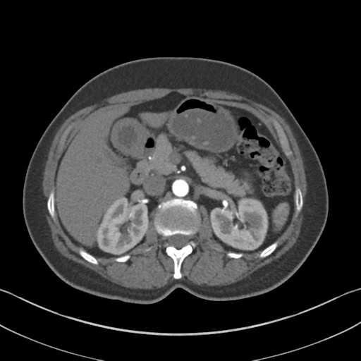 File:Normal CT renal artery angiogram (Radiopaedia 38727-40889 A 35).png