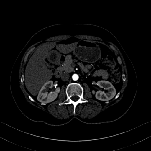 File:Normal CT renal artery angiogram (Radiopaedia 38727-40889 C 20).png