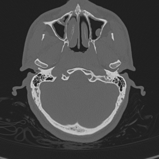 Normal CT skull (Radiopaedia 40798-43459 A 27).png