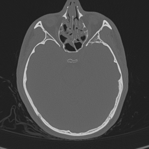 Normal CT skull (Radiopaedia 40798-43459 A 56).png