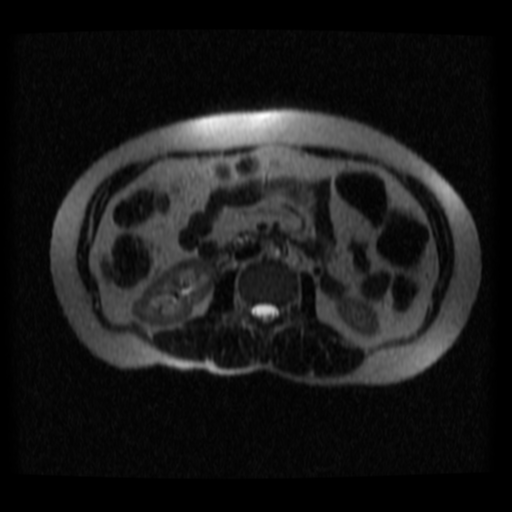 File:Normal MRCP (Radiopaedia 41966-44978 Axial T2 thins 2).png