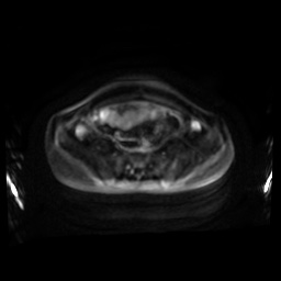 Normal MRI abdomen in pregnancy (Radiopaedia 88001-104541 Axial DWI 55).jpg