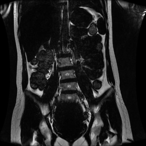 Normal MRI abdomen in pregnancy (Radiopaedia 88001-104541 N 82).jpg