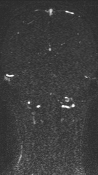 Normal MRI brain with MRV- teenager (Radiopaedia 49425-54553 Coronal MRV 171).jpg