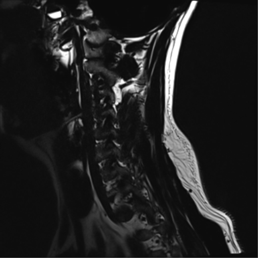 File:Normal MRI cervical spine (infection protocol) (Radiopaedia 53916-60039 F 4).png