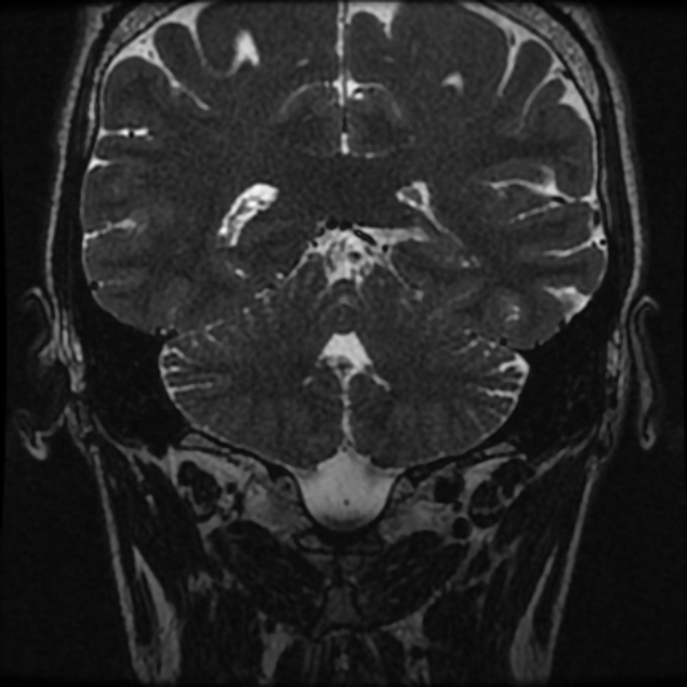 Normal MRI petrous (Radiopaedia 91317-108949 Coronal T2 88).jpg