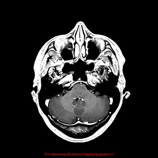 Normal adult brain MRI (non-enhanced and contrast-enhanced) (Radiopaedia 75262-86379 Axial T1 C+ 67).jpg