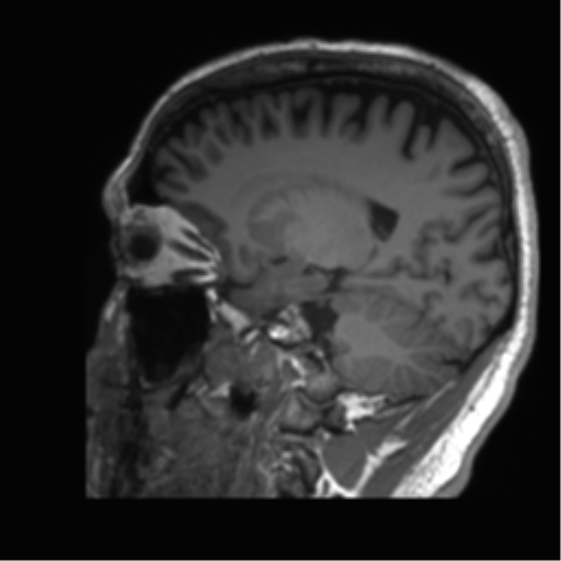 Normal brain MRI (non-focal epilepsy protocol) (Radiopaedia 53917-60040 Sagittal T1 44).png