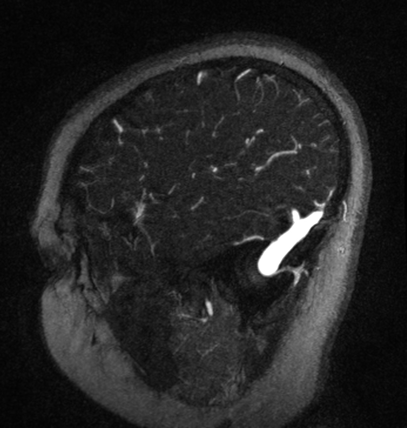 Normal brain MRI and venogram (Radiopaedia 39554-41862 Sagittal MRV 10).jpg