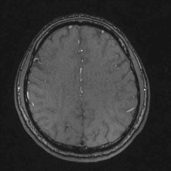 Normal brain MRI including MRA (Radiopaedia 48748-53763 Axial MRA 154).jpg