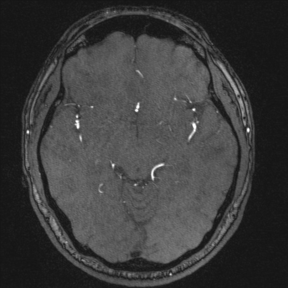 Normal brain MRI including MRA (Radiopaedia 48748-53763 Axial MRA 94).jpg