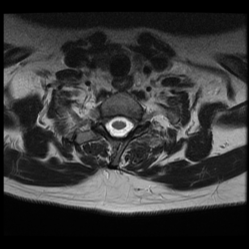 File:Normal cervical and thoracic spine MRI (Radiopaedia 35630-37156 Axial T2 7).png