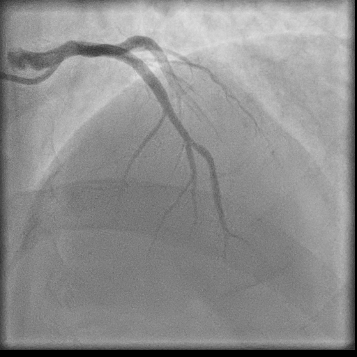 Normal coronary angiogram (DSA) (Radiopaedia 63081-71571 E 20).jpg