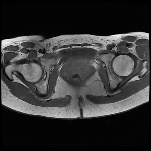 File:Normal female pelvis MRI (retroverted uterus) (Radiopaedia 61832-69933 Axial T1 23).jpg