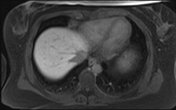 File:Normal hepatobiliary phase liver MRI (Radiopaedia 58968-66230 A 15).jpg