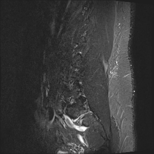 File:Normal lumbar spine MRI (Radiopaedia 47857-52609 Sagittal STIR 3).jpg