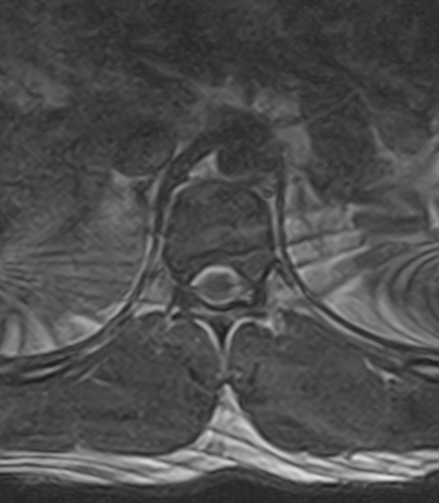 Normal lumbar spine MRI - low-field MRI scanner (Radiopaedia 40976-43699 Axial T2 2).jpg