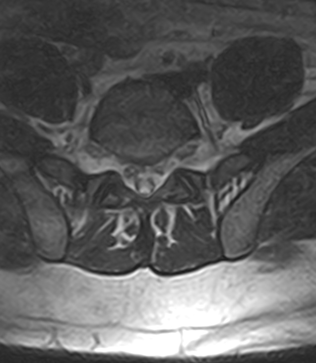 Normal lumbar spine MRI - low-field MRI scanner (Radiopaedia 40976-43699 Axial T2 85).jpg