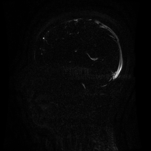 Normal noncontrast MR venography (Radiopaedia 87578-103957 A 91).jpg