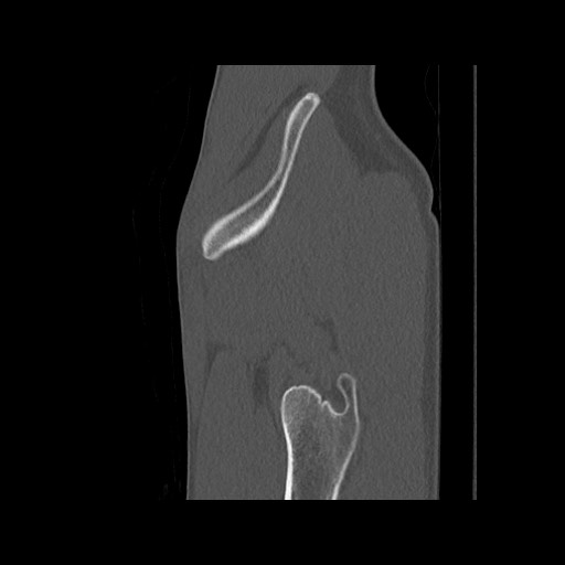 Normal pelvis (Radiopaedia 51473-57238 Sagittal bone window 131).jpg