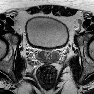 File:Normal prostate (MRI) (Radiopaedia 29986-30535 Axial T2 15).jpg