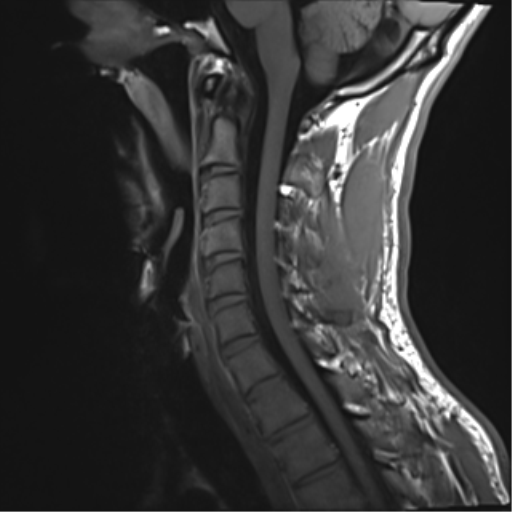 File:Normal trauma cervical spine (Radiopaedia 41017-43762 Sagittal T1 7).png