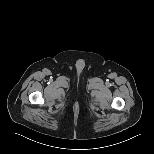 File:Obstructing sigmoid adenocarcinoma (Radiopaedia 58465-65619 A 180).jpg