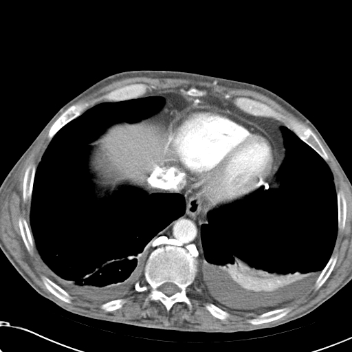 File:Obstructive superior vena cava tumor thrombus (Radiopaedia 28046-28306 A 44).jpg