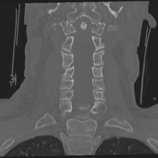 File:Occipital condyle fracture (Radiopaedia 33467-34517 Coronal bone window 33).png