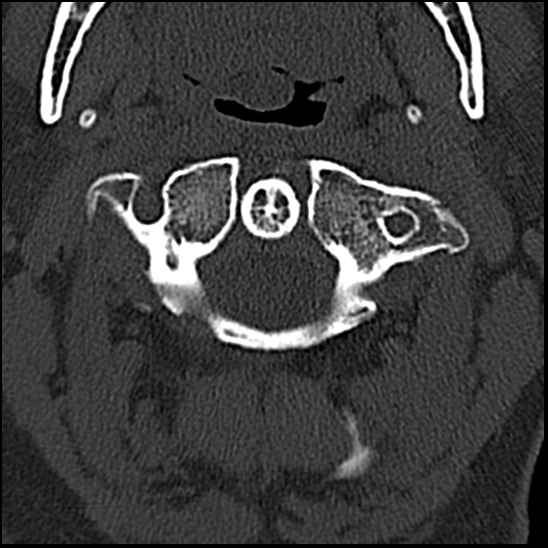 Occipital condyle fracture (type 1) (Radiopaedia 87670-104084 Axial bone window 19).jpg