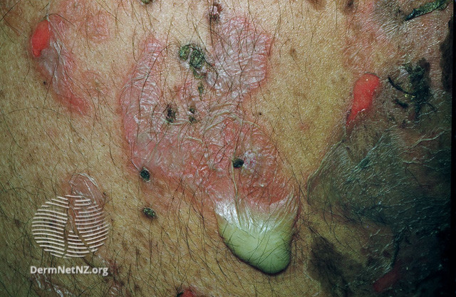 File:Pemphigus vulgaris (DermNet NZ immune-pgus3).jpg