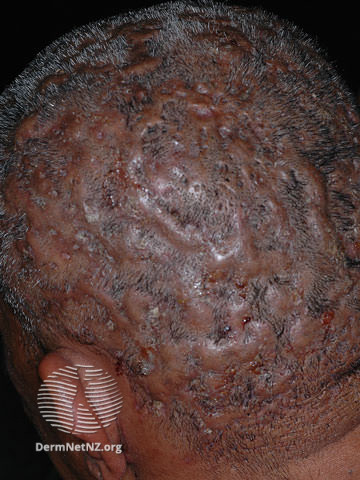 File:Perifolliculitis capitis abscedens et suffodiens (DermNet NZ acne-perifolliculitis2).jpg