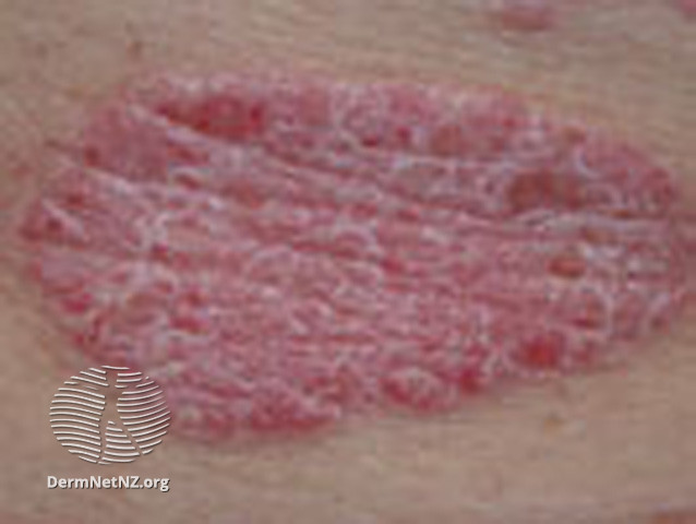File:Psoriasis (DermNet NZ scaly-thick3).jpg